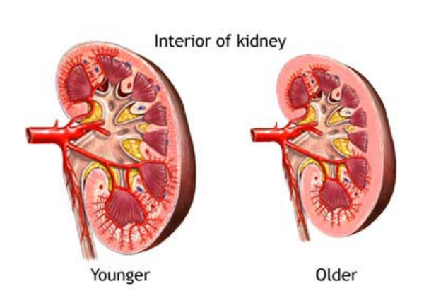 Comparison image of the interior of two kidneys - in young health and old health